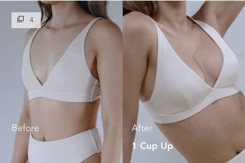 Mia Femtech Breast Implant Harmonization Before After